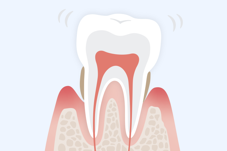 歯周病治療イメージ