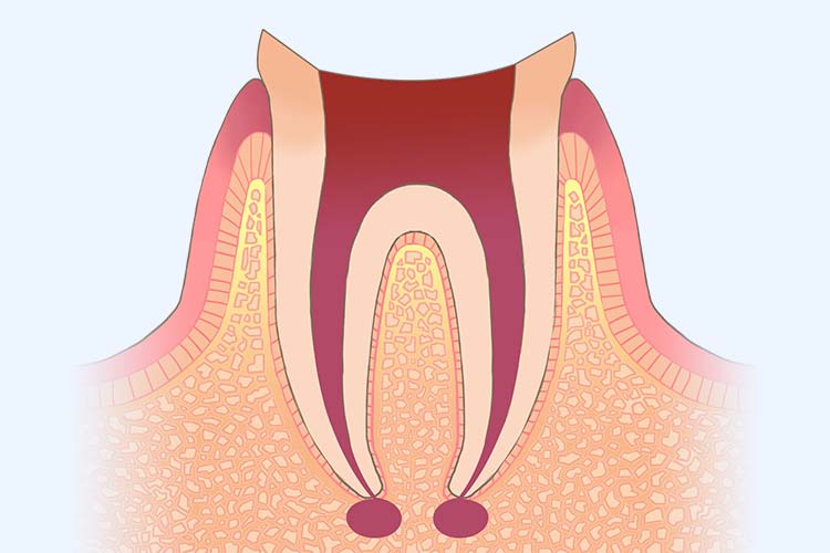 根管治療（根の治療）イメージ